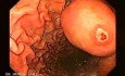Endoscopy of gastric leiomyoma