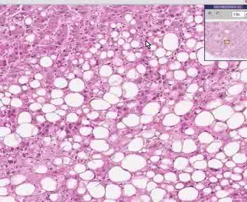 Liver - Fatty Change 2