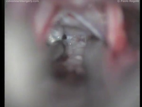 PCA Epidermoid - Right Retrosigmoid Approach