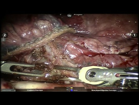 Robotic Lung Surgery Post Neoadjuvancy