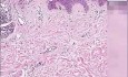 Compound nevus with halo reaction