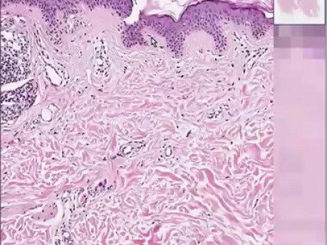 Compound nevus with halo reaction