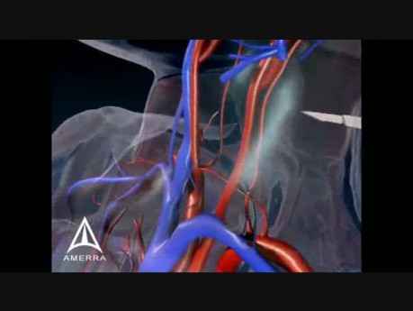 Carotid Endarectomy - 3D Medical Animation