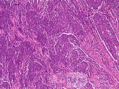 Adenocarcinoma of the Antrum and incisura angularis (11 of 12)