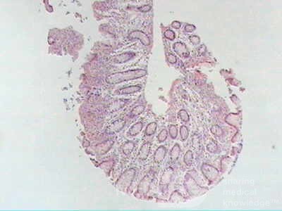Trichuris Trichuris (whipworm) (18 of 19)