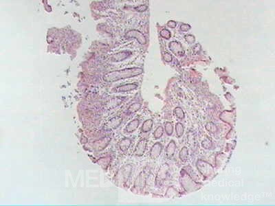 Trichuris Trichuris (whipworm) (18 of 19)