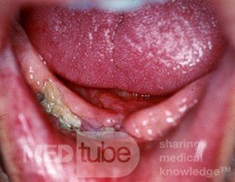 Radiation Osteonecrosis [mandible]