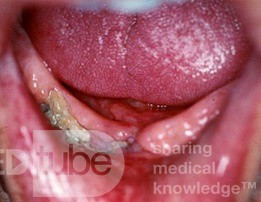 Radiation Osteonecrosis [mandible]