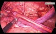 Laparoscopic Hernia Repair Large Sac TAPP Repair