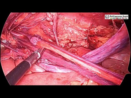 Laparoscopic Hernia Repair Large Sac TAPP Repair