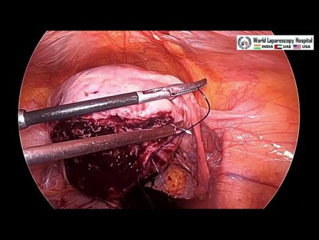 Laparoscopic Management of Posterior Intramural Fibroid