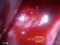 Cervical adenocarcinoma (carcinoma glandulare colli uteri)