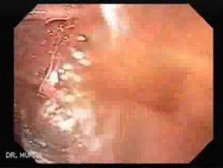 Brunner's Gland Adenoma (1 of 2)