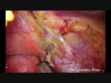 Single-Port Thoracoscopic Thymectomy