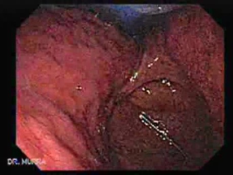Esophagus - Pneumatic Dilation for Achalasia - Video from the Procedure