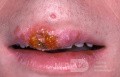 Early Herpes Simplex Upper Lip