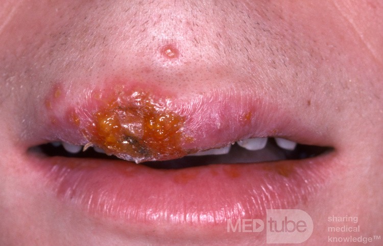 Early Herpes Simplex Upper Lip