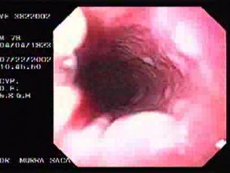 Esophageal Glycogenic Acanthosis - Assessment of Esophageal Mucosa
