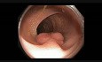 Pedunculated Polyp In The Colon