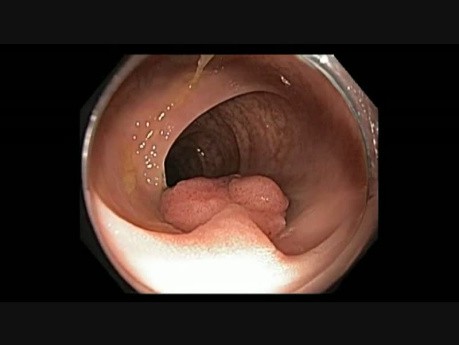 Pedunculated Polyp In The Colon