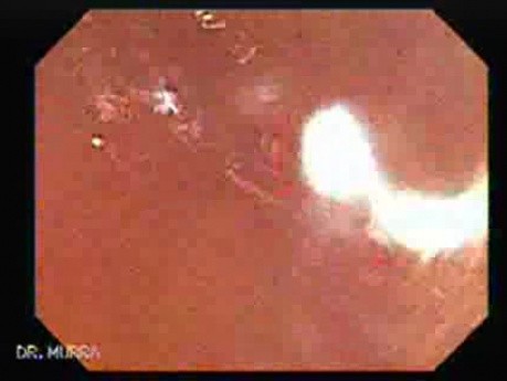 Schistosoma Mansoni in the Cecum (2 of 9)