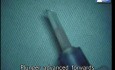 Endoshield injector in endothelial keratoplasty