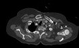 AVR + MVR + Tricuspid Valve Repair - Redo Case - Minimally Invasive Approach