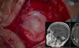 Resection of an Infratentorial Meningioma of the Right Cerebellar Hemisphere
