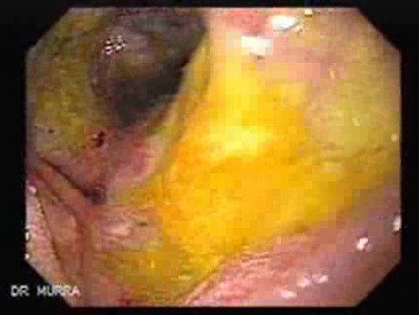 Gastroduodenal MALT lymphoma (6 of 9)