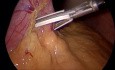 Laparoscopic Gastric Sleeve with Three Trocars