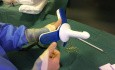 Treatment of Bleeding and Prolapsed Piles with Non Excisional Technique