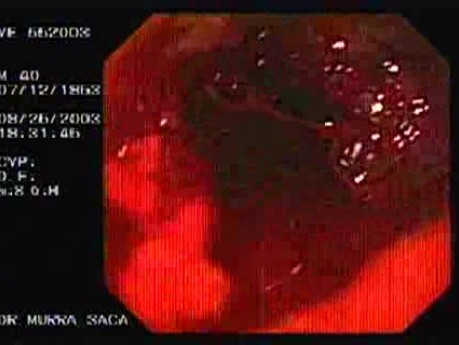 Acute Variceal Bleeding - Searching For the Site of Bleeding