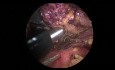 Left VATS Thymectomy Using Transcollation Technology