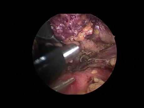Left VATS Thymectomy Using Transcollation Technology