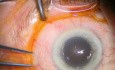 Replacing of Two Calcificated Lenses, 5 yrs After Implantation
