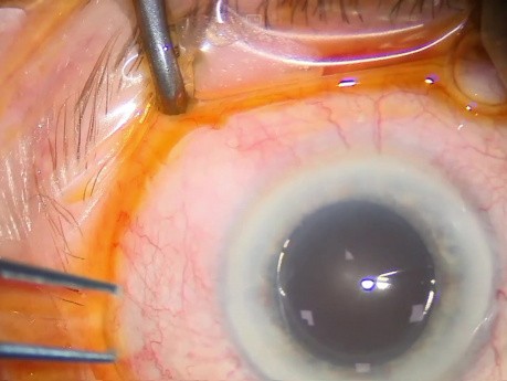Replacing of Two Calcificated Lenses, 5 yrs After Implantation