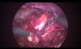 Retroperitoneal Laparoscopic Surgery for Removing Renal Tumor