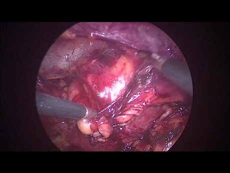 Retroperitoneal Laparoscopic Surgery for Removing Renal Tumor