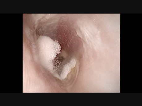 Otomycosis of the Left Ear