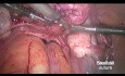 Temporary Ligation if the Uterine Artery Using the "Shoe Lace" Knot Before Laparoscopy Myomectomy
