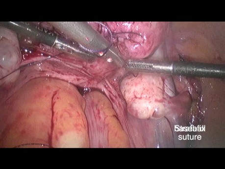 Temporary Ligation if the Uterine Artery Using the "Shoe Lace" Knot Before Laparoscopy Myomectomy