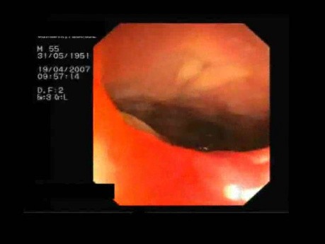 Rectal Perforation