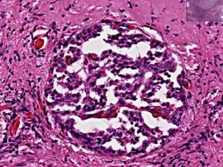 Islet cell tumor (insulinoma) - Histopathology pancreas