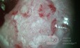 Colposcopy - Invasive Squamous-Cell Carcinoma