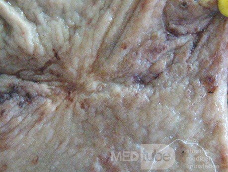 Small Gastric Adenocarcinoma of the Diffuse Ring Cell (19 of 19)