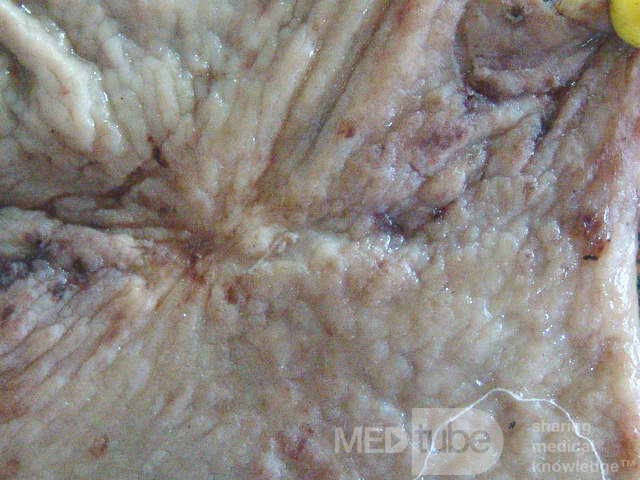 Small Gastric Adenocarcinoma of the Diffuse Ring Cell (19 of 19)