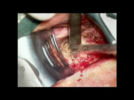 Forestier's disease