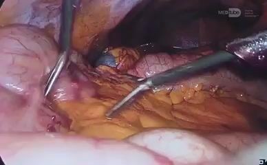 Extended laparoscopic right hemicolectomy