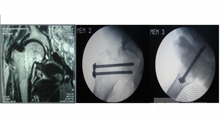Stress fracture of Rt. femoral neck