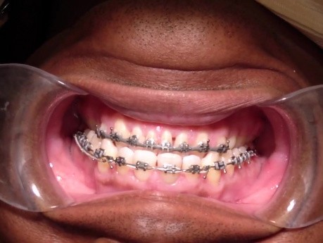 Orthodontic Case #4 - One Method To Retract Anterior Maxillary Segment W/ Surgical Hooks And Coil